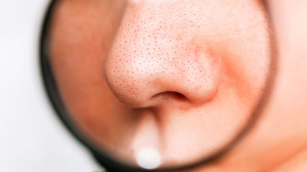 Пазете се! Изстискването на пъпки около носа увеличава риска от инсулт