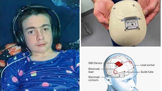 Имплантираха на тийнейджър с епилепсия първия в света мозъчен невростимулатор