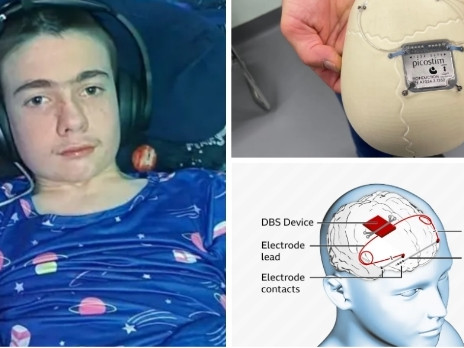 Имплантираха на тийнейджър с епилепсия първия в света мозъчен невростимулатор
